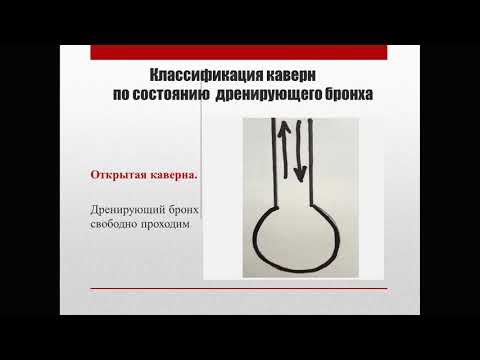 Видео: Фтизитария. Кавернозный туберкулез, ФКТ, цирротический