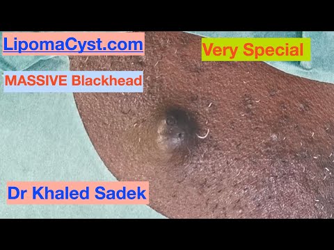 Видео: 7 лет, большой черный угорь. Доктор Халед Садек. LipomaCyst.com