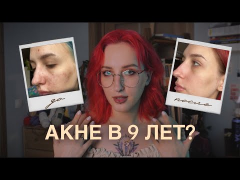 Видео: Моя акне история. Как я лечила кожу от прыщей?