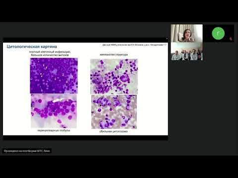 Видео: Редкие опухоли. Карцинома Меркеля (вебинар 1 марта 2024)