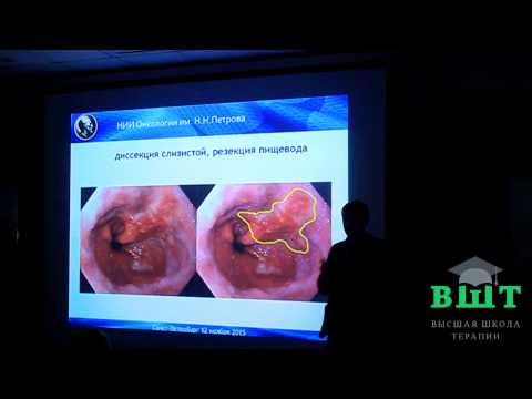 Видео: 27.10.16 Лечение ГЭРБ, пищевод Баррета (7 часть)