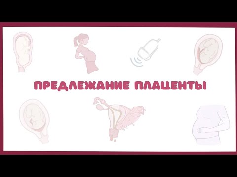 Видео: Предлежание плаценты - причины, симптомы, лечение (акушерство) лекция