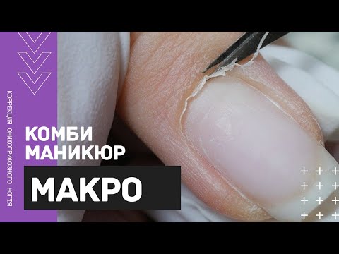 Видео: МАКРО комби маникюр 🔍Коррекция КЛЮЮЩЕГО ногтя акригелем 💅 Геометрический маникюр 2020