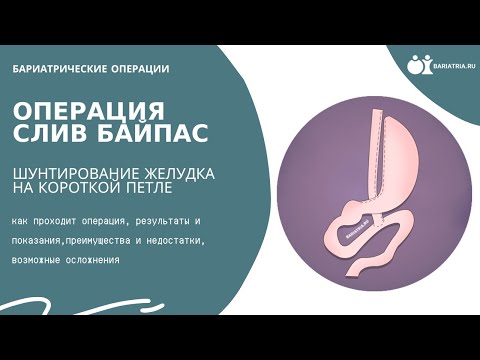 Видео: Шунтирование желудка на короткой петле (слив байпас)