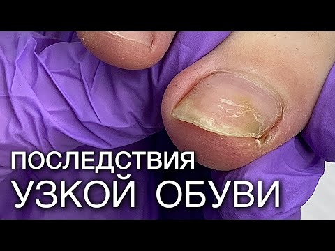 Видео: ДИНАМИКА обработки вросшего ногтя