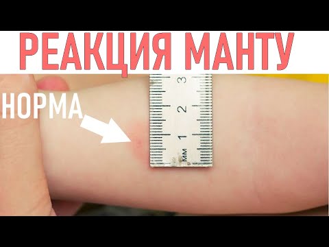 Видео: ПРОВЕРКА РЕАКЦИИ НА МАНТУ | Нормы для детей разного возраста
