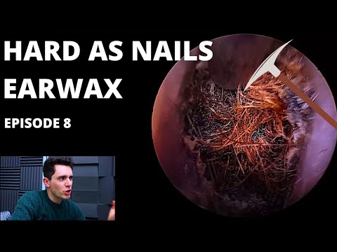 Видео: Твёрдая как гвозди ушная сера ЭПИЗОД 8