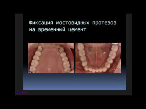 Видео: Вебинар Сидоров В.И. Протезирование на имплантатах. 2 часть.
