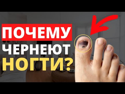 Видео: КАК ВЫЛЕЧИТЬ ЧЕРНЫЕ НОГТИ НА НОГАХ? Только 1% Знает, Почему Ногти На Ногах Чернеют!