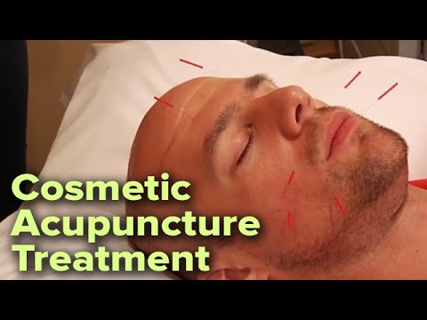 Видео: Косметическая акупунктура для лица | Улучшает тон кожи и уменьшает морщины естественным путем
