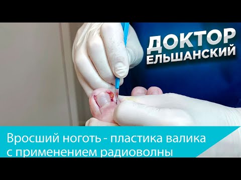 Видео: Вросший ноготь пластика валика с радиоволной