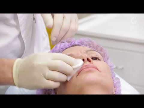 Видео: Мезотерапия лица техникой наппаж. Препарат NCTF