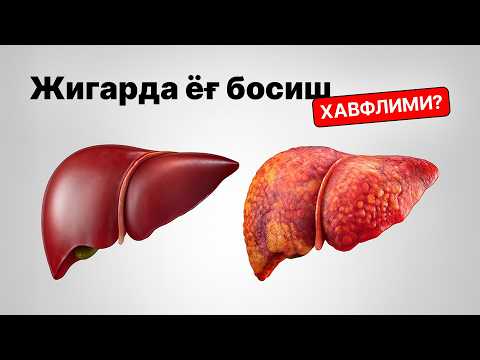 Видео: Жигарда ёғ босиш Жигар Циррозига олиб келадими?