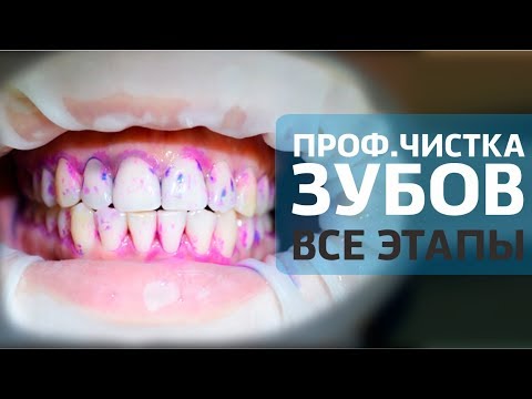 Видео: Чистка зубов AIR FLOW - все этапы | Как проходит профессиональная чистка зубов | Дентал ТВ