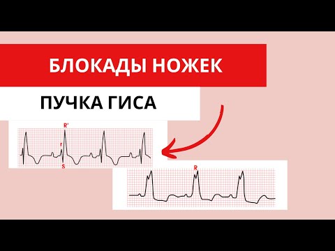 Видео: Блокады ножек пучка Гиса. Как различать на ЭКГ?