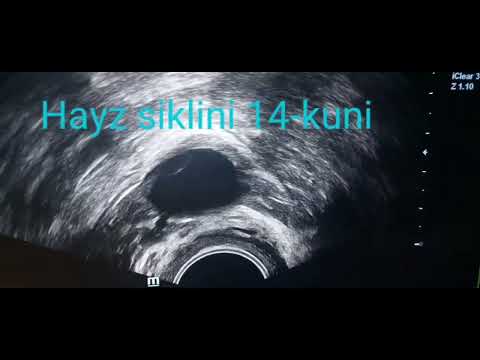 Видео: Фолликулометрия. Фолликуламетрия нима?Зоб касаллигининг хомиладорликка таъсири.