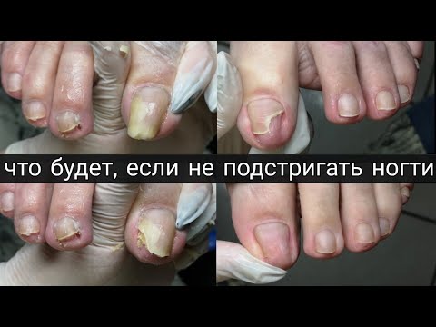 Видео: Онихолизис на ногтях. Полгода не стригла ногти на ногах. Лечение, удаление, зачистка