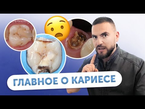 Видео: Что важно знать о кариесе