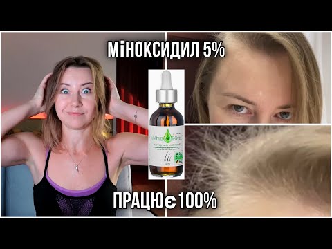 Видео: Міноксидил (Mino-Max 5%)1 раз в день - результат через 2 місяці🔥
