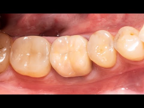 Видео: Изготовление Cerec реставраци (полная версия)