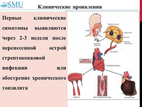 Видео: Острая ревматическая лихорадка