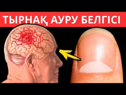 Видео: ТЫРНАҚ осылай болса сізде осы 6 АУРУ бар деген сөз. Тырнаққа қарап ауруларды анықтау методы