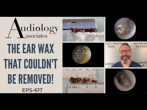 Видео: Ушная сера, которую невозможно было удалить - EP617