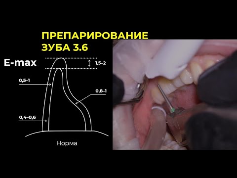Видео: ПРЕПАРИРОВАНИЕ ВИТАЛЬНОГО 3.6 ЗУБА РАБОТА В МИКРОСКОП (полный гайд)