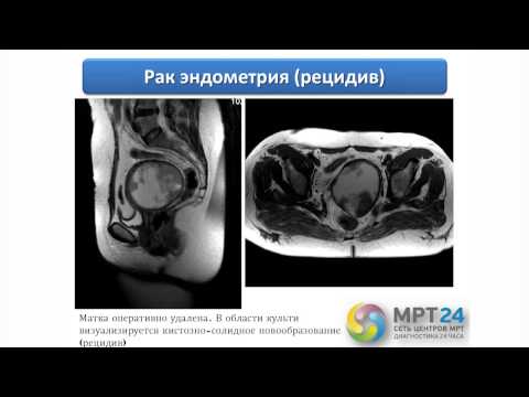 Видео: Мельников Женский малый таз Мастер-класс