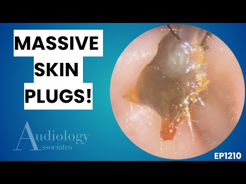 Видео: Извлечение деликатной кожи длиной 8,5 см - EP1210