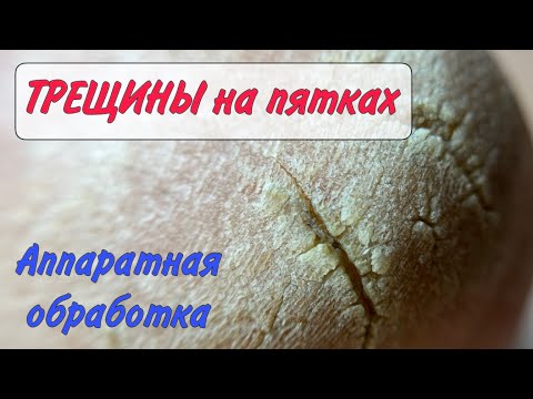 Видео: Трещины на пятках / Как убрать трещины на пятках / Медицинский педикюр