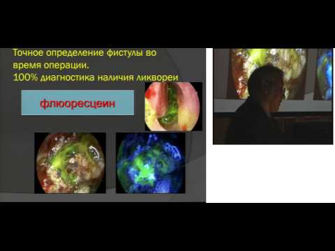 Видео: 6  проф  Д Н Капитанов  Базальная ликворея эндоназальные подходы
