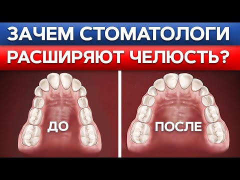 Видео: Зачем нужно РАСШИРЯТЬ ЧЕЛЮСТЬ?! Вся правда про расширители челюсти