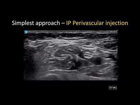 Видео: Подмышечная блокада плечевого сплетения под контролем УЗИ — простое руководство