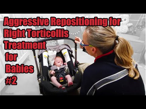 Видео: # 2R Лечение агрессивного репозиции правого тортиколлиса: лечение тортиколлиса у младенцев