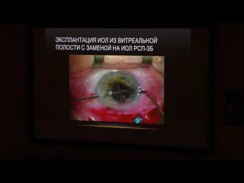 Видео: Модификация зрачковой ИОЛ для снижения риска дислокации