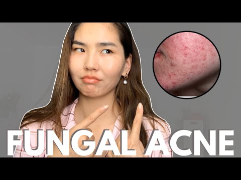 Видео: Fungal Acne гэж юу вэ? | Fungal acne үүсэх шалтгаан, шинж тэмдэг, арчилгаа