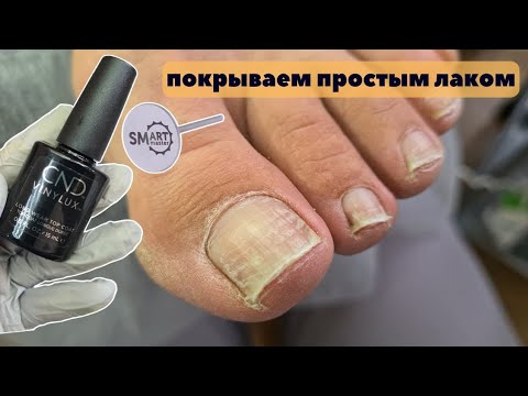 Видео: Педикюр с обычным лаком. Подногтевая мозоль. Повреждённые ногти. Смарт педикюр