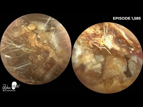 Видео: 1585 — Третье успешное удаление ушной серы