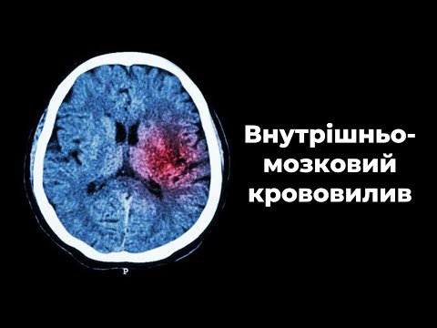 Видео: Внутрішньомозковий крововилив