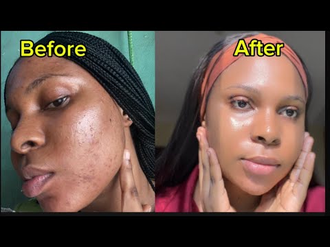 Видео: 5 вещей, которые нужно сделать, чтобы быстро избавиться от любого типа гиперпигментации. Проверен...