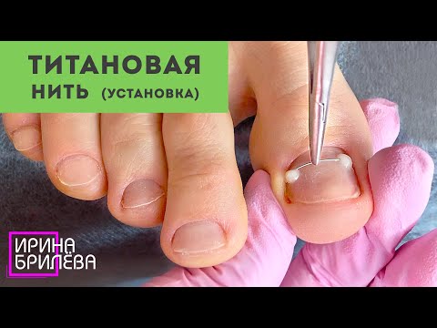 Видео: Установка ТИТАНОВОЙ НИТИ (NiTi) 🌸 Педикюр (убираем подногтевые мозоли) 🌸 Ирина Брилёва