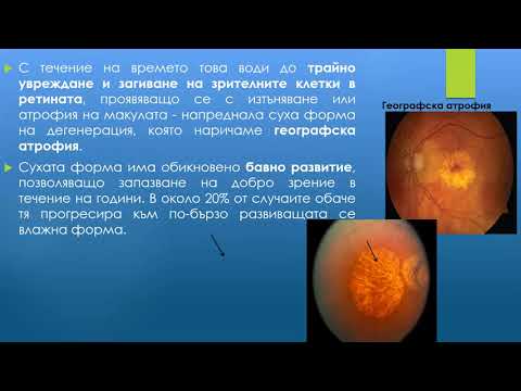 Видео: Дегенерация на макулата, свързана с възрастта - д-р Милена Милкова