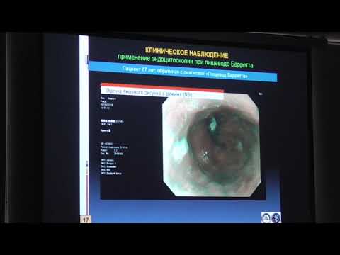 Видео: 54 Пирогов СС Пищевод Барретта 2019  Что нового