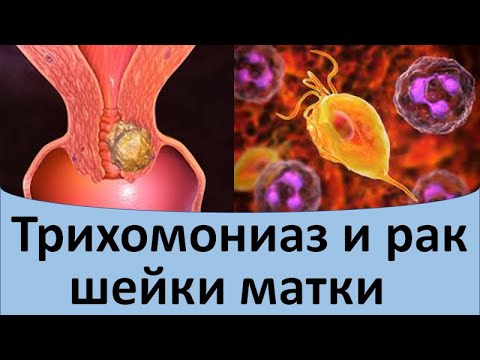 Видео: Трихомониаз и рак шейки матки