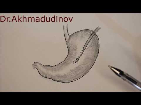 Видео: Гастростомия по Витцелю, gastrostomy