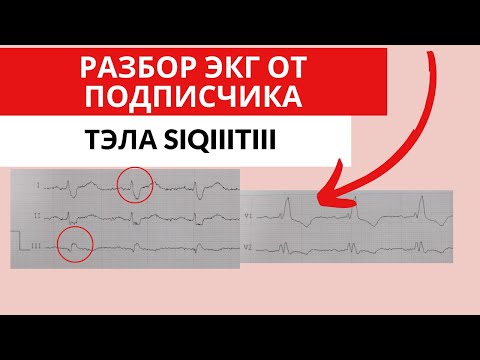 Видео: Разбор ЭКГ от подписчика. ОКС или ТЭЛА?