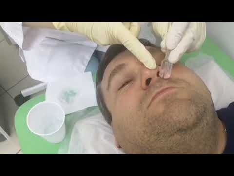 Видео: Процедура "Кукушка" эффективна при гайморите