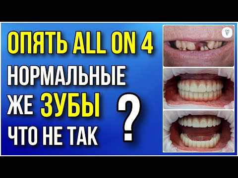 Видео: Опять это ALL on 4 или как новые зубы НЕ сделали пациентку счастливой. Имплантация зубов. #dentist
