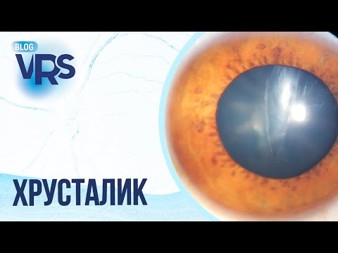 Видео: Травма глаза / Хрусталик